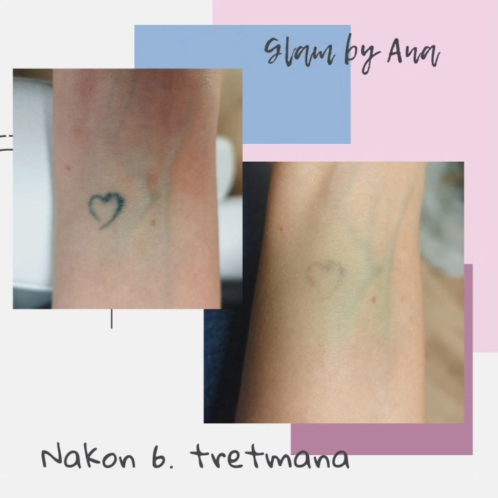 Uz Glam by Ana uklonite trajnu šminku i tetovaže bez boli!