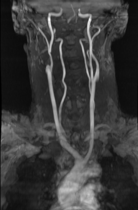 Svjetski dan zdravlja: Ateroskleroza svjetski ubojica broj jedan