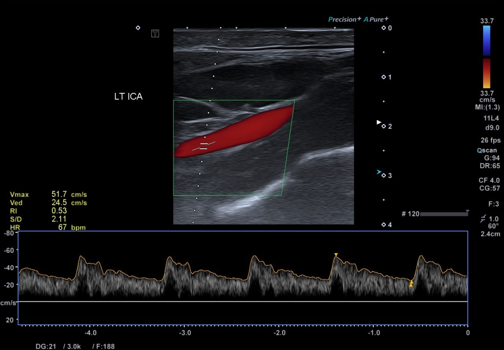 Svjetski dan zdravlja: Ateroskleroza svjetski ubojica broj jedan