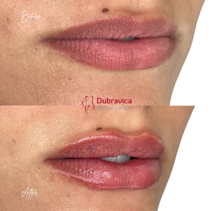 FOTO Dan žena u Dubravici: Iskoristite popust na najnovije trendove u estetskoj medicini 