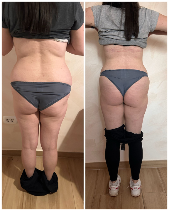 FOTO Beauty Clinic by Tamara: Smanjite celulit i ovo ljeto prošetajte plažom samouvjereno!