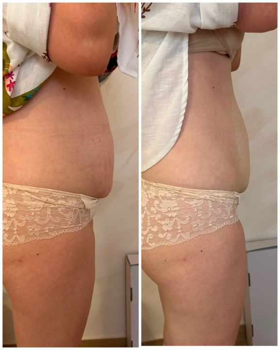FOTO Želite zategnutiju kožu, ali ne želite pod nož? Tamara ima rješenje koje tražite!