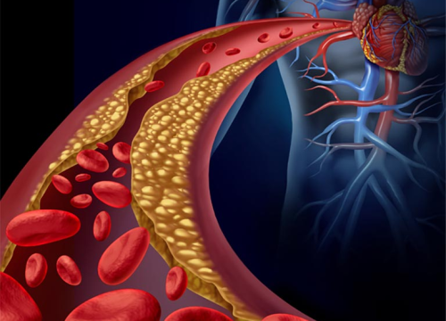 Fotografija 2 - Svjetski dan zdravlja: Ateroskleroza svjetski ubojica broj jedan