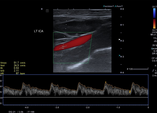 Fotografija 5 - Svjetski dan zdravlja: Ateroskleroza svjetski ubojica broj jedan