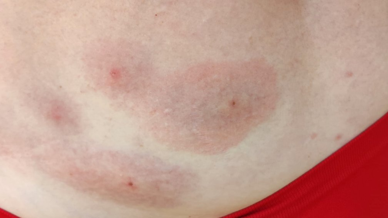 Kakve su to pješčane muhe koje su navodno izgrizle Slovence na Murteru?