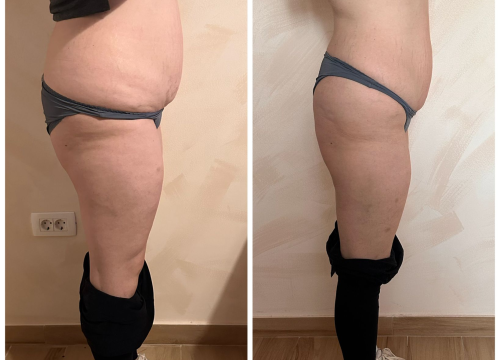 Fotografija 1 - FOTO Skinite do 10 kilograma u 6 tjedana uz Beauty Clinic by Tamara