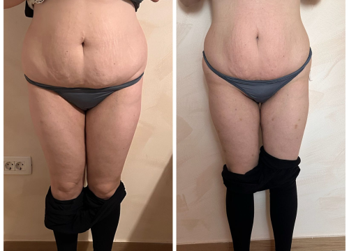 Fotografija 5 - FOTO Skinite do 10 kilograma u 6 tjedana uz Beauty Clinic by Tamara