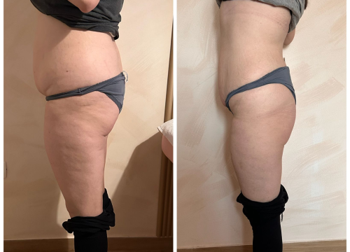 Fotografija 7 - FOTO Skinite do 10 kilograma u 6 tjedana uz Beauty Clinic by Tamara