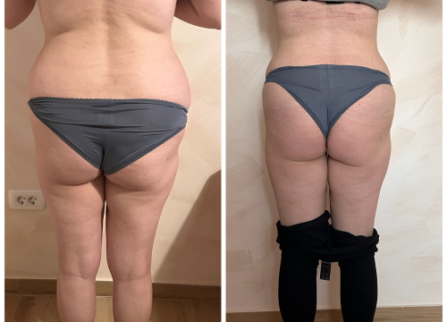 Fotografija 11 - FOTO Skinite do 10 kilograma u 6 tjedana uz Beauty Clinic by Tamara