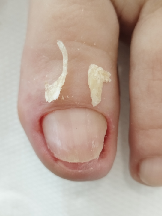 Riješite se uraslih noktiju uz medicinsku pedikuru!