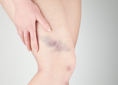 Što znače neobjašnjive modrice i što možete poduzeti da se one ne pojavljuju?