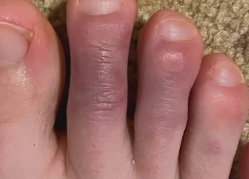 'Covid prsti' mogli bi biti nuspojava odgovora imunosnog sustava