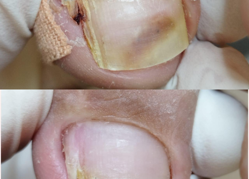 Fotografija 2 - Pružite svojim stopalima maksimalnu njegu i riješite tegobe uz medicinsku pedikuru!