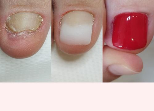 Fotografija 4 - Pružite svojim stopalima maksimalnu njegu i riješite tegobe uz medicinsku pedikuru!