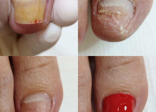 Fotografija 9 - Pružite svojim stopalima maksimalnu njegu i riješite tegobe uz medicinsku pedikuru!