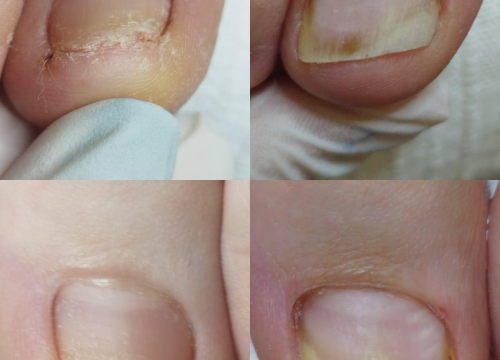 Fotografija 10 - Pružite svojim stopalima maksimalnu njegu i riješite tegobe uz medicinsku pedikuru!