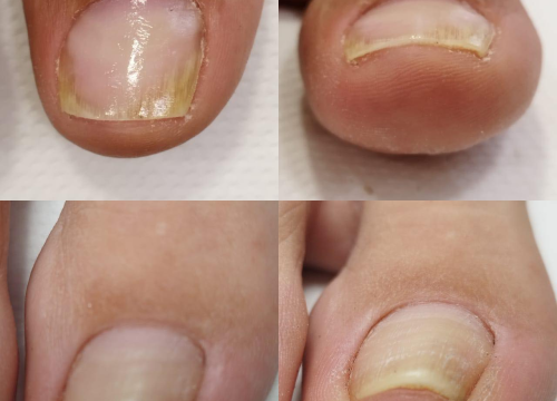 Fotografija 12 - Pružite svojim stopalima maksimalnu njegu i riješite tegobe uz medicinsku pedikuru!