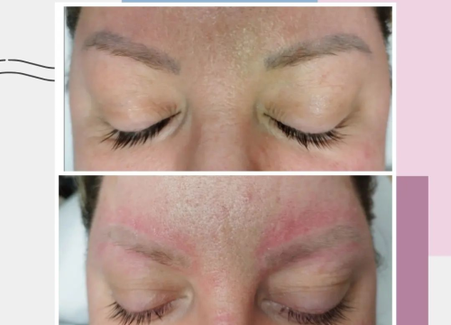 Fotografija 4 - Uz Glam by Ana uklonite trajnu šminku i tetovaže bez boli!