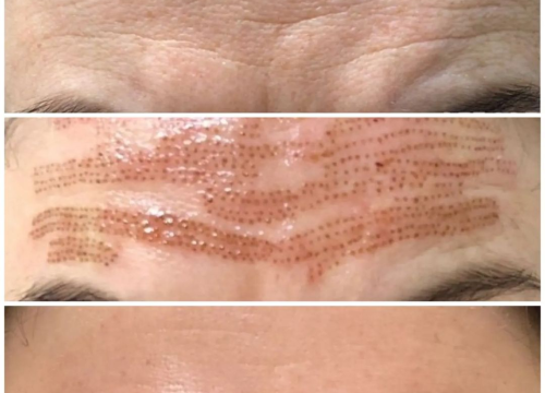 Fotografija 6 - Uz Glam by Ana uklonite trajnu šminku i tetovaže bez boli!