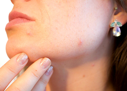 Dobro je znati: Saznajte što vaše tijelo treba prema poziciji akni