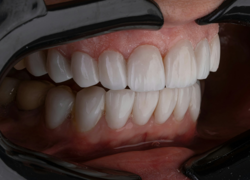 Stomatologinja otkrila naviku koja uništava zube, a mnogi to rade svaki dan