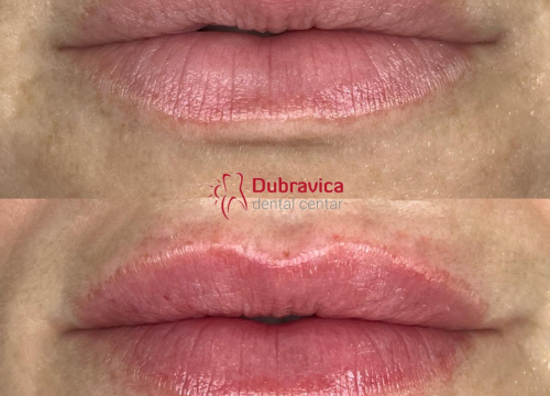 Fotografija 1 - FOTO Dan žena u Dubravici: Iskoristite popust na najnovije trendove u estetskoj medicini