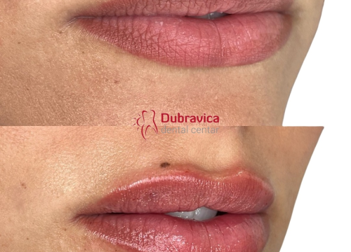 Fotografija 4 - FOTO Dan žena u Dubravici: Iskoristite popust na najnovije trendove u estetskoj medicini