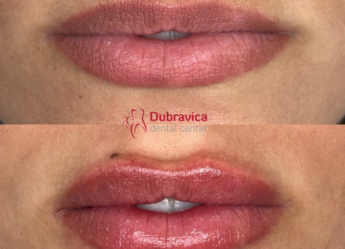 Fotografija 2 - FOTO Dan žena u Dubravici: Iskoristite popust na najnovije trendove u estetskoj medicini