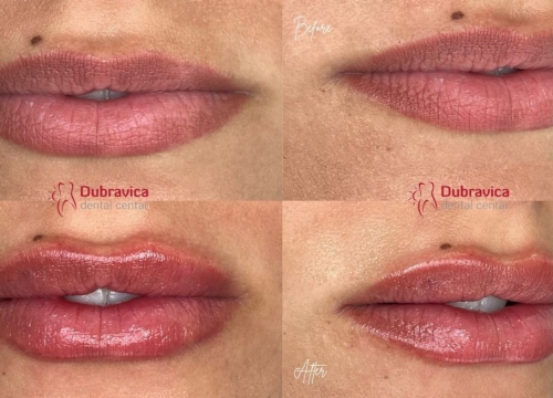 Fotografija 6 - FOTO Dan žena u Dubravici: Iskoristite popust na najnovije trendove u estetskoj medicini