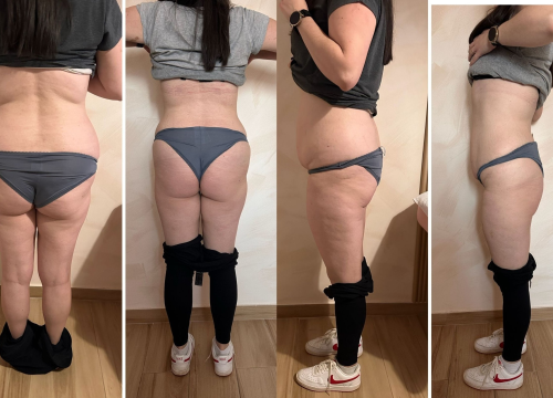 Fotografija 19 - FOTO Beauty Clinic by Tamara: Smanjite celulit i ovo ljeto prošetajte plažom samouvjereno!