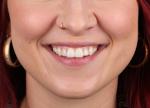 Fotografija 9 - FOTO Transformirajte osmijeh prozirnim alignerima u Dental centru Dubravica!