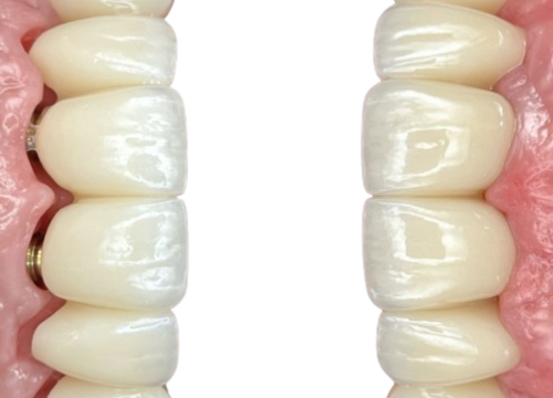 Fotografija 5 - FOTO Životna prekretnica uz Dental centar Dubravica: Što trebate znati prije ugradnje implantata